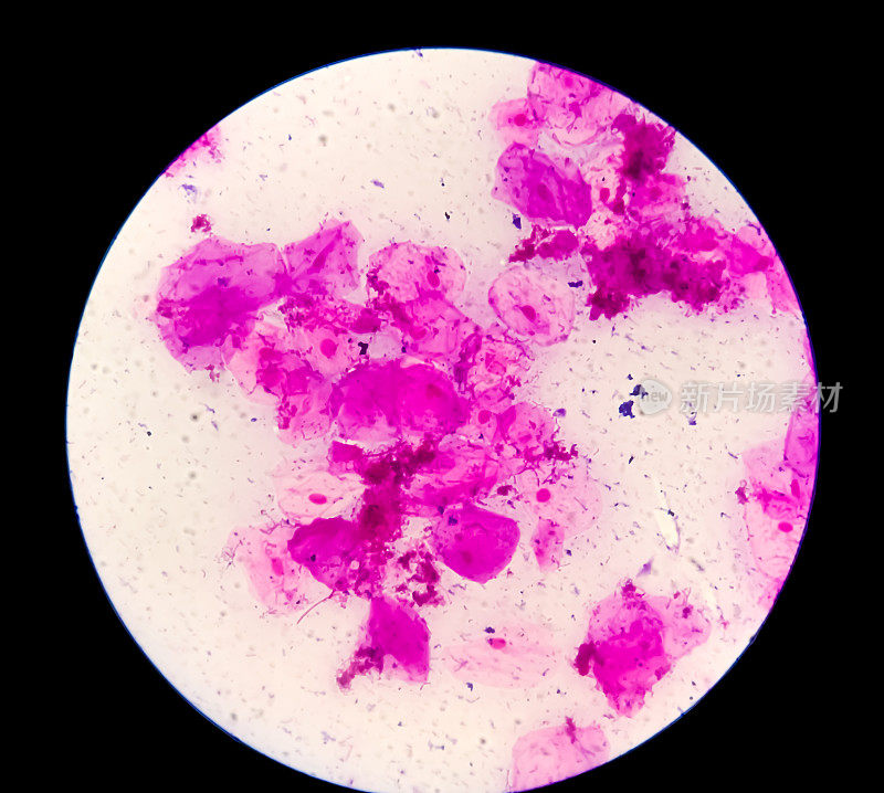 前列腺涂片(P/S)革兰氏染色镜下100x可见少量脓细胞和上皮细胞。革兰氏阳性双球菌数量多，革兰氏阴性杆状细菌数量少。